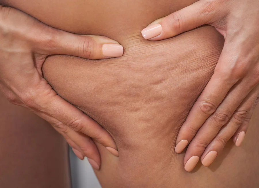 Cellulite: pelle a buccia d’arancia sulla coscia