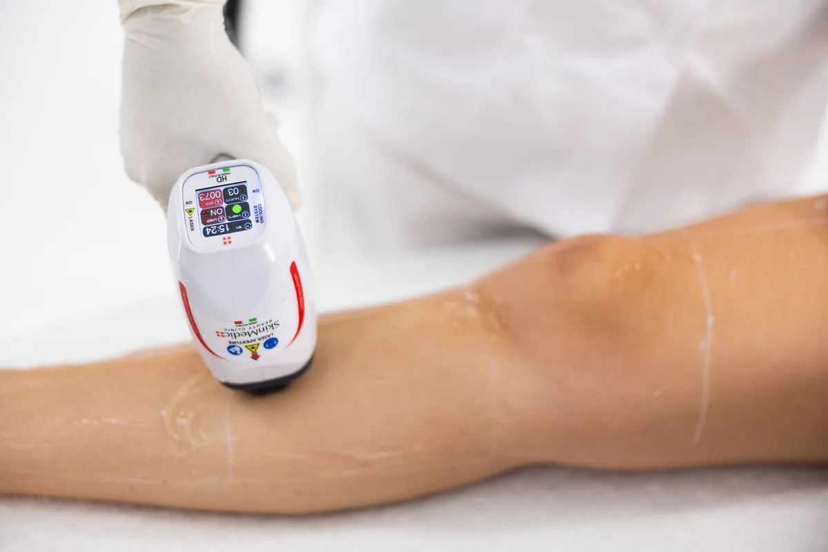 Epilazione laser